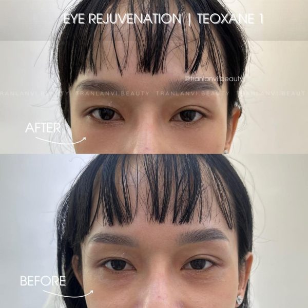 Teoxane Teosyal Puresense Redensity [I] – Trẻ hóa toàn diện cho vùng da mắt